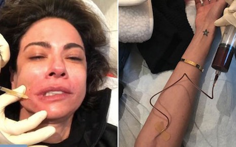 Luciana Gimenez publicou fotos do tratamento feito com seu próprio sangue no Instagram - Reprodução/Instagram