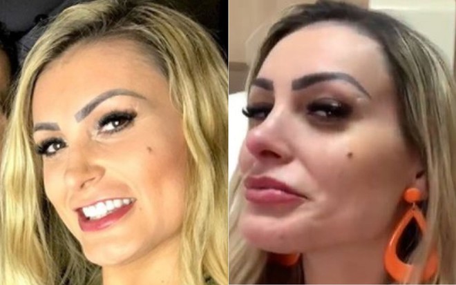 Andressa Urach antes de empinar o nariz; Andressa Urach logo após o procedimento, com o nariz vermelho