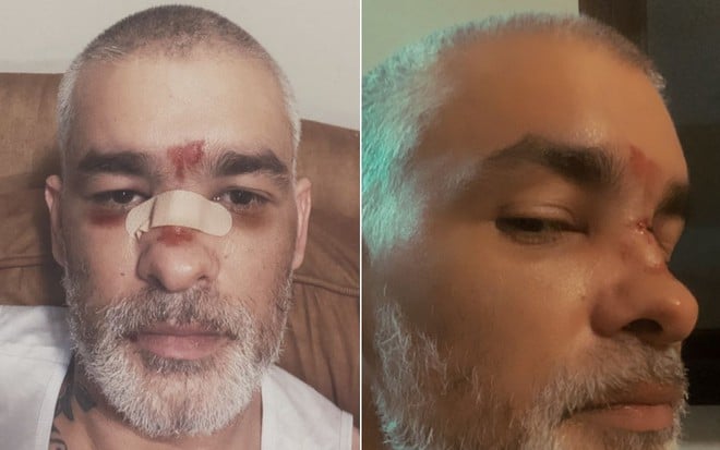 Montagem com o rosto de Esteban Tavares com o rosto machucado após o acidente doméstico