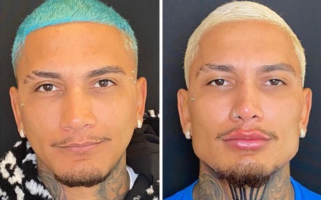Dynho Alves mostra o antes e depois de sua harmonização facial