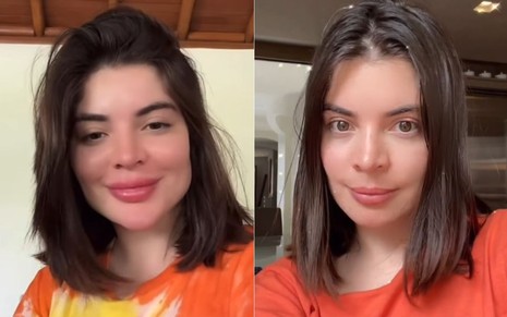 Antes e depois de Gkay com preenchimento labial