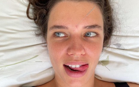 A atriz Bruna Linzmeyer sorri com agulhas no rosto em foto publicada no Instagram