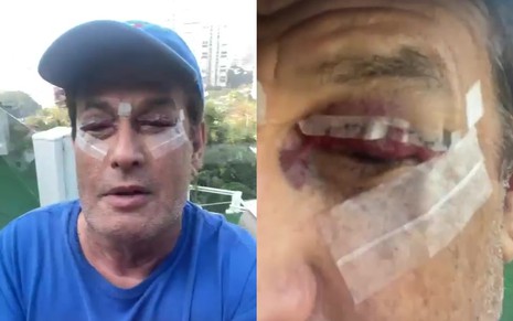 Sérgio Mallandro com os olhos inchados por causa da cirurgia de ptose palpebral
