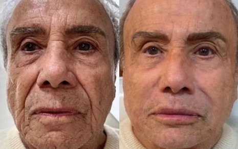 Stênio Garcia antes (à esquerda) e depois (direita) de harmonização facial