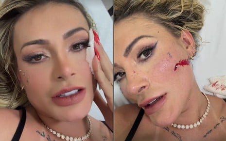 Montagem de Andressa Urach no hospital, mostrando ferimento no rosto