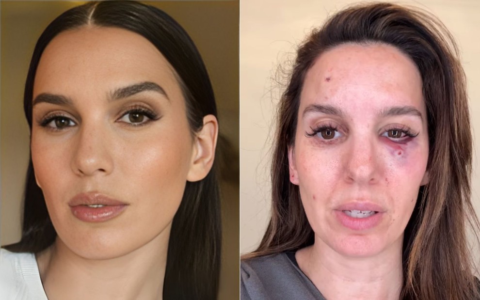 Montagem com fotos de Christy Carlson Romano; à esquerda, ela aparece maquiada, à direita, com o olho roxo após ser baleada