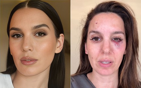 Montagem com fotos de Christy Carlson Romano; à esquerda, ela aparece maquiada, à direita, com o olho roxo após ser baleada
