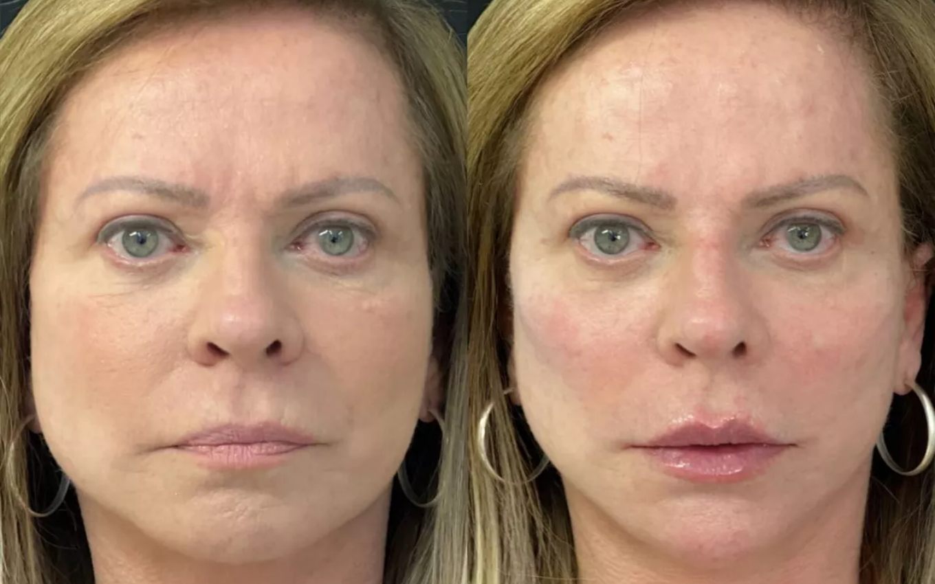 Christina Rocha muda o rosto com harmonização facial; veja antes e depois ·  Notícias da TV
