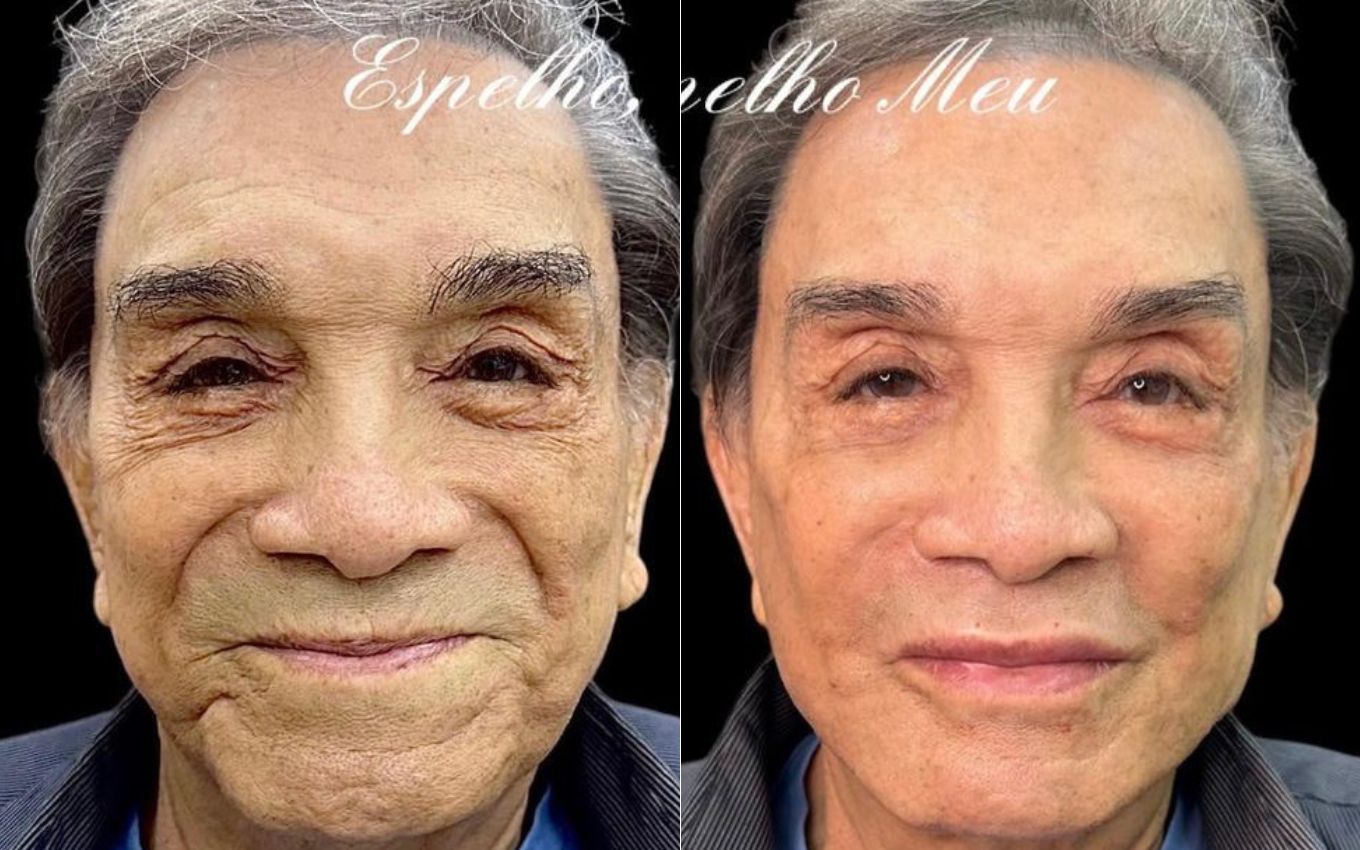 Antes e depois - Harmonia Facial