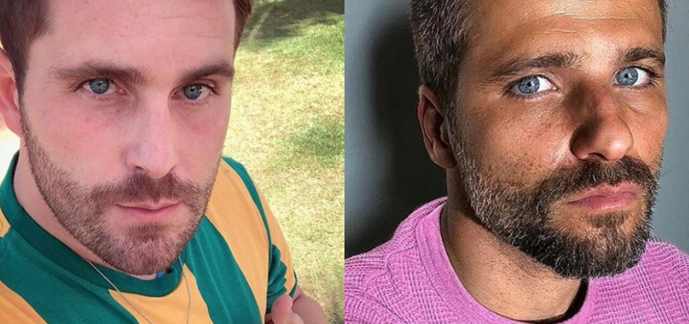 Antes e depois: veja os famosos que fizeram harmonização facial - ISTOÉ  Independente